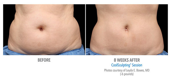 CoolSculpting® Before and After Pictures Savannah, GA