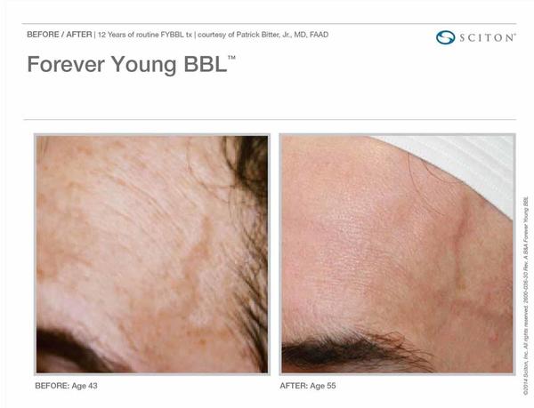 Skin Tightening Before and After Pictures Savannah, GA