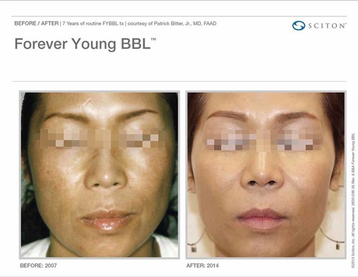 Skin Tightening Before and After Pictures Savannah, GA