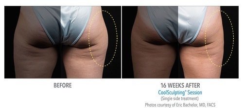 CoolSculpting® Before and After Pictures Savannah, GA