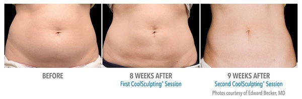 CoolSculpting® Before and After Pictures Savannah, GA