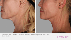 Skin Resurfacing in Savannah, GA