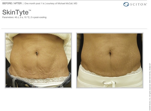 Skin Tightening Before and After Pictures Savannah, GA