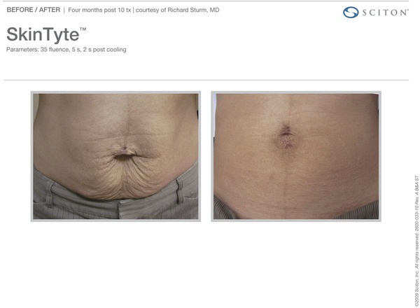 Skin Tightening Before and After Pictures Savannah, GA