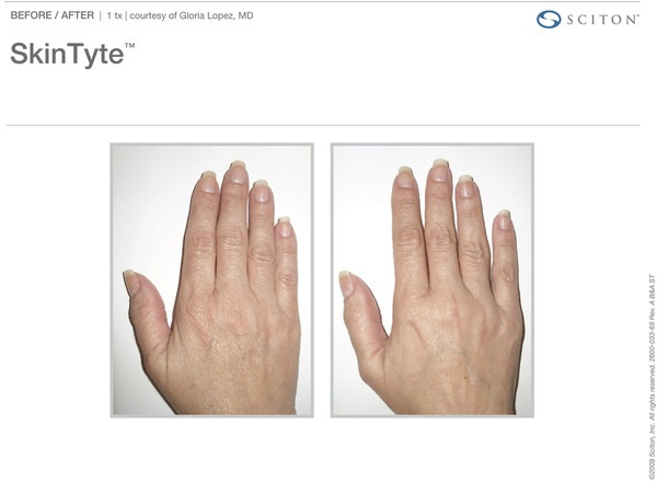 Skin Tightening Before and After Pictures Savannah, GA