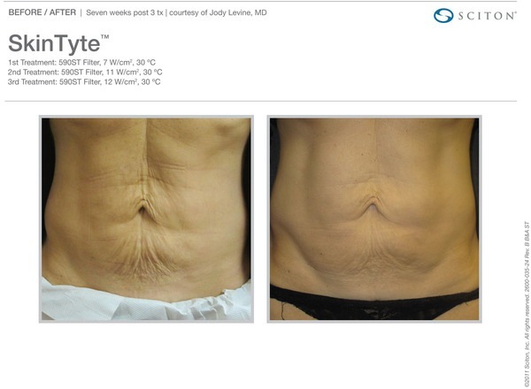 Skin Tightening Before and After Pictures Savannah, GA