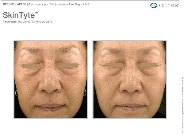 Skin Tightening Before and After Pictures Savannah, GA