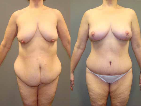 Mommy Makeover Before and After Pictures Savannah, GA
