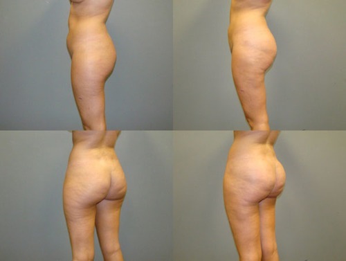 Brazilian Butt Lift Before and After Pictures Savannah, GA