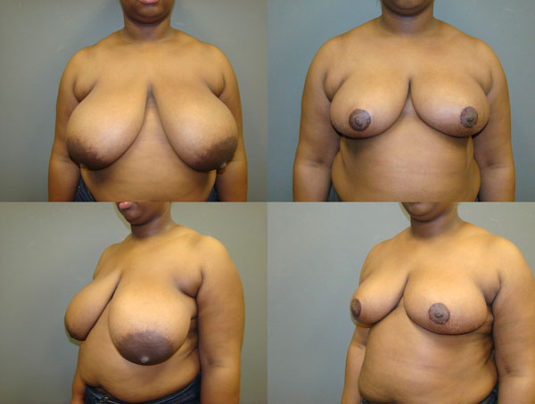 Breast Reduction Before and After Pictures Savannah, GA