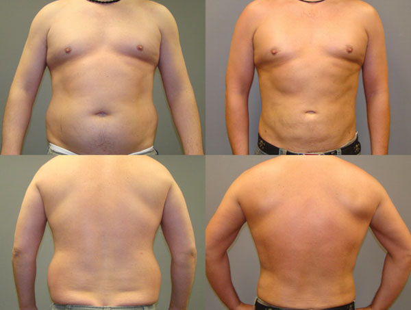 Male Breast Reduction (Gynecomastia Surgery) Before and After Pictures Savannah, GA