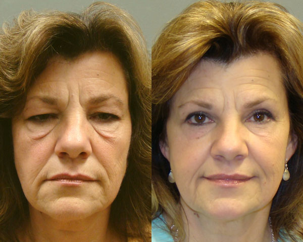Eyelid Surgery Before and After Pictures Savannah, GA