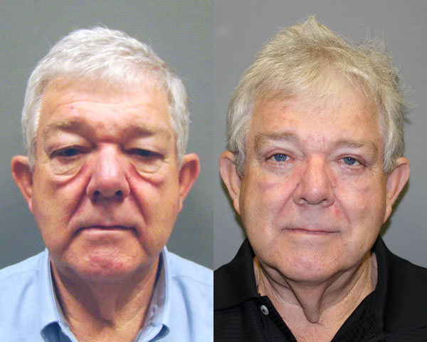 Eyelid Surgery Before and After Pictures Savannah, GA