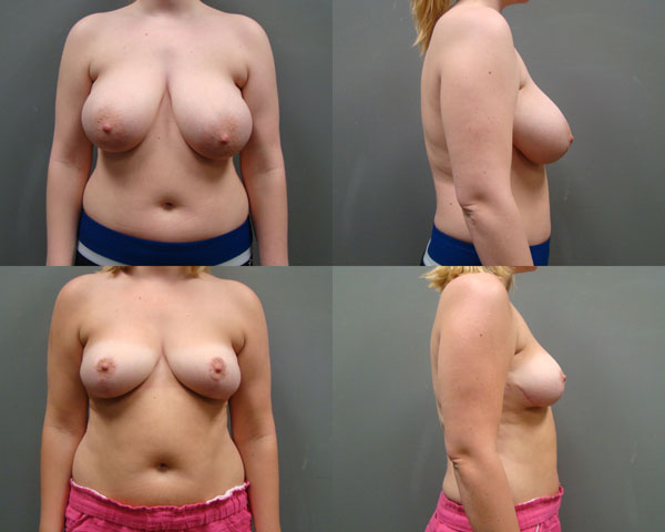 Breast Reduction Before and After Pictures Savannah, GA