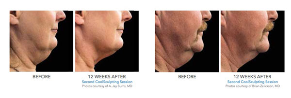 CoolSculpting® Before and After Pictures Savannah, GA