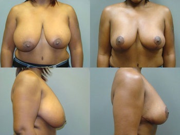 Breast Reduction Before and After Pictures Savannah, GA