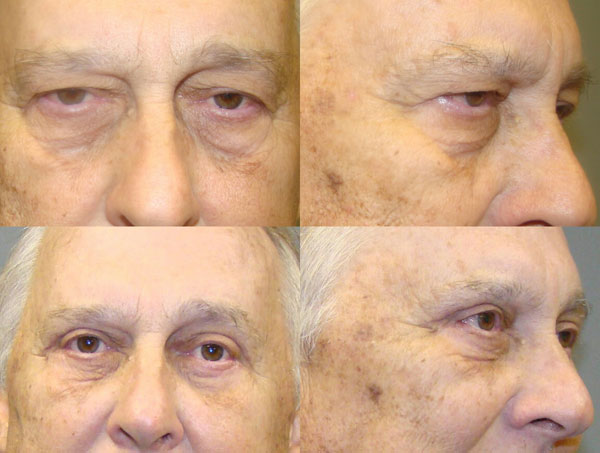 Eyelid Surgery Before and After Pictures Savannah, GA
