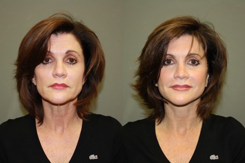 FreshLook Lift® Before and After Pictures Savannah, GA