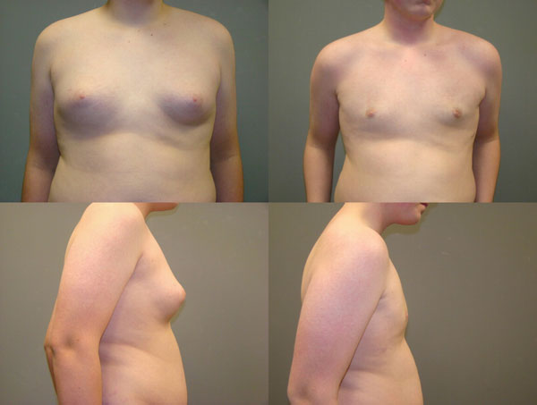 Male Breast Reduction (Gynecomastia Surgery) Before and After Pictures Savannah, GA