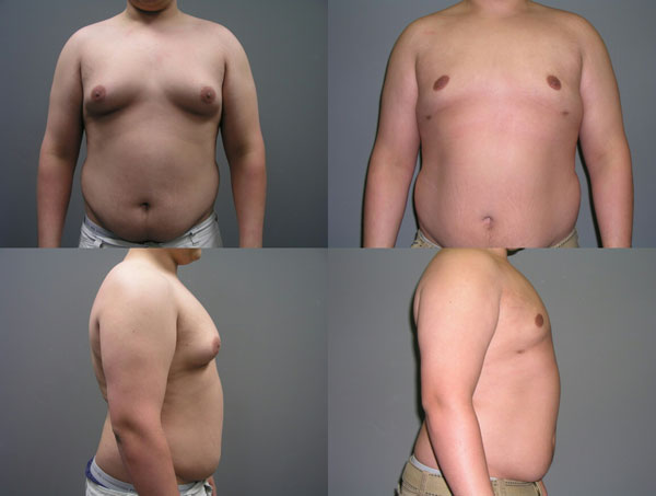 Male Breast Reduction (Gynecomastia Surgery) Before and After Pictures Savannah, GA