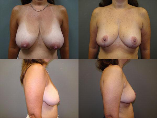 Breast Reduction Before and After Pictures Savannah, GA