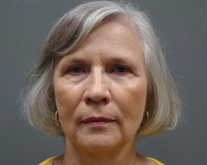 Eyelid Surgery Before and After Pictures Savannah, GA