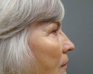 Eyelid Surgery Before and After Pictures Savannah, GA