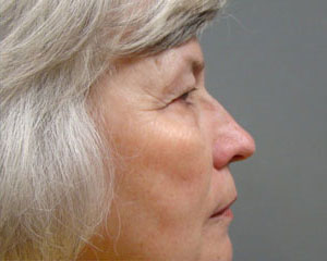 Eyelid Surgery Before and After Pictures Savannah, GA