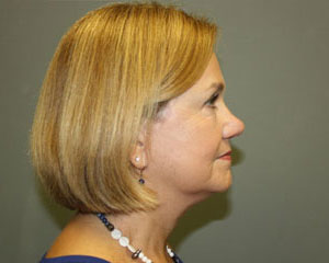 Before and After Pictures in Savannah, GA