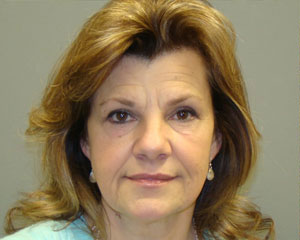 Eyelid Surgery Before and After Pictures Savannah, GA