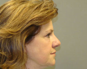 Eyelid Surgery Before and After Pictures Savannah, GA