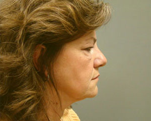 Eyelid Surgery Before and After Pictures Savannah, GA