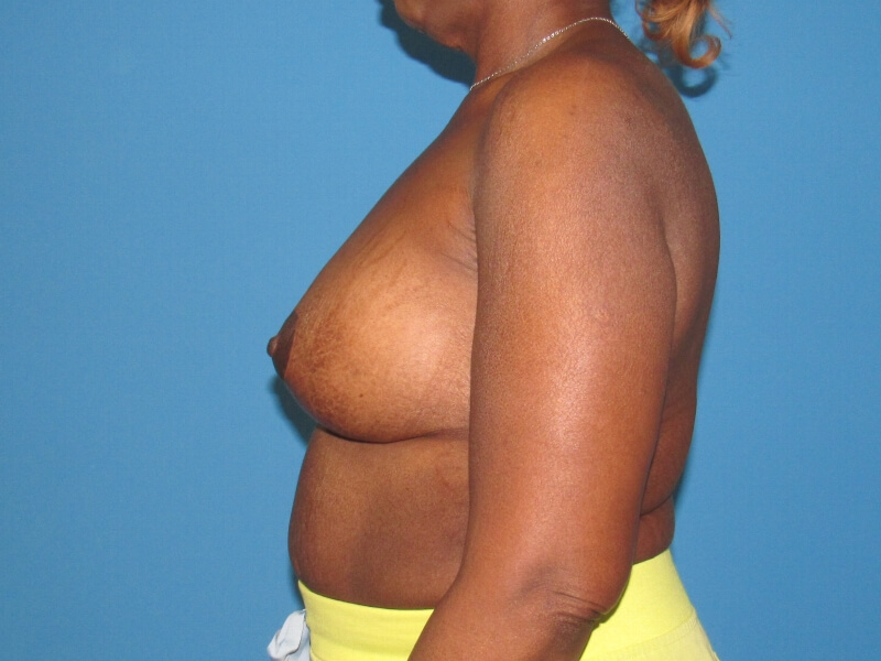 Before and After Pictures in Savannah, GA