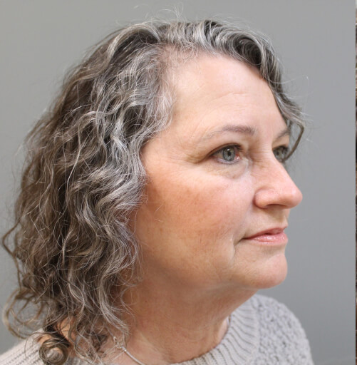 Before and After Pictures in Savannah, GA