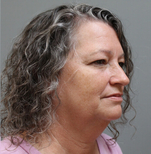 Before and After Pictures in Savannah, GA