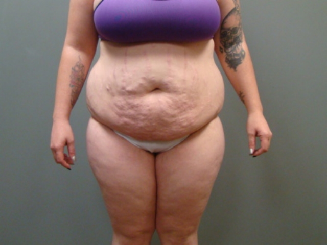 Before and After Pictures in Savannah, GA