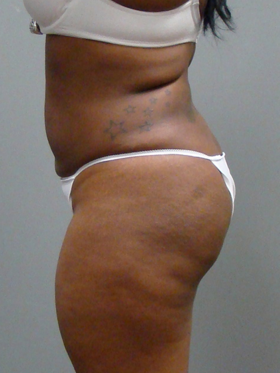 Before and After Pictures in Savannah, GA