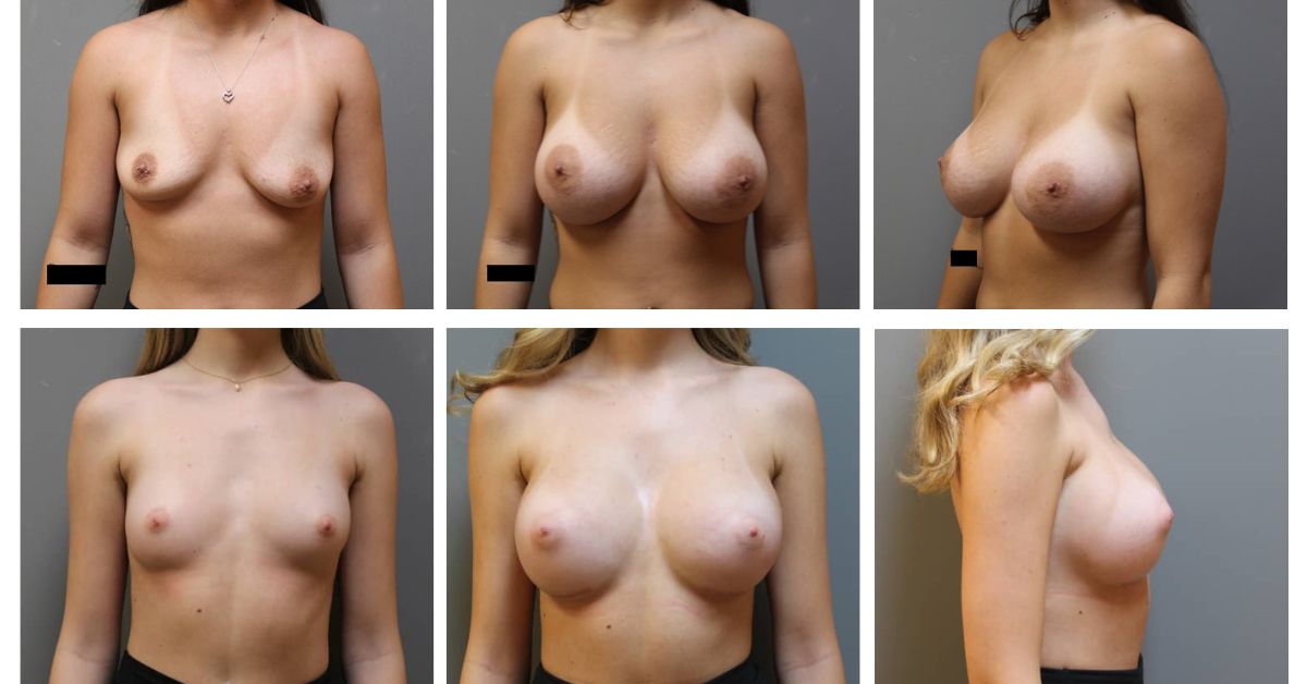 SPS-Blog-Feature-Image-1-1 Two Breast Augmentation Before and After Case Photos