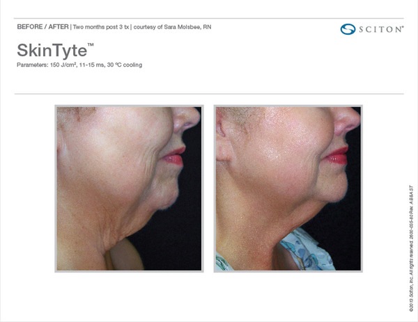 Skin Tightening Before and After Pictures Savannah, GA