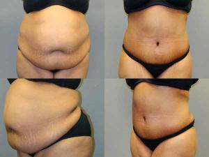 Tummy Tuck Before and After Pictures Savannah, GA