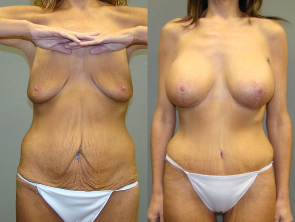 Tummy Tuck Before and After Pictures Savannah, GA