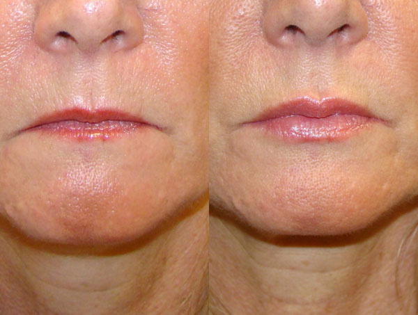 Dermal Fillers & Injectables Before and After Pictures Savannah, GA