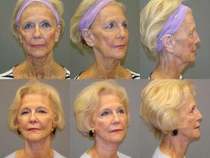 Facelift Before and After Pictures Savannah, GA