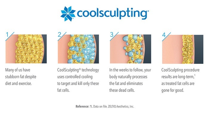 CoolSculpting® in Savannah, GA