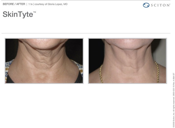 Skin Tightening Before and After Pictures Savannah, GA