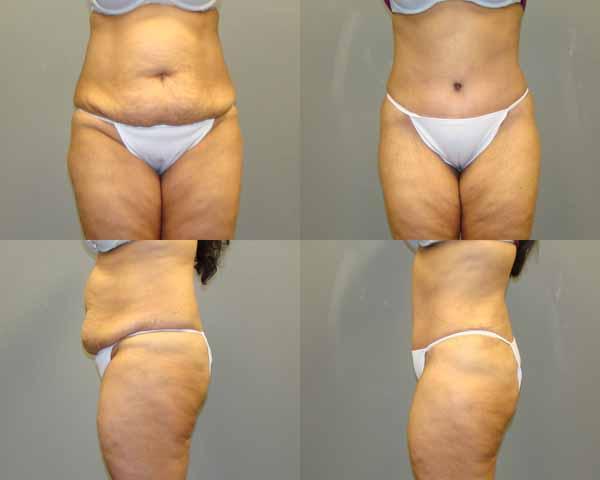 Tummy Tuck Before and After Pictures Savannah, GA