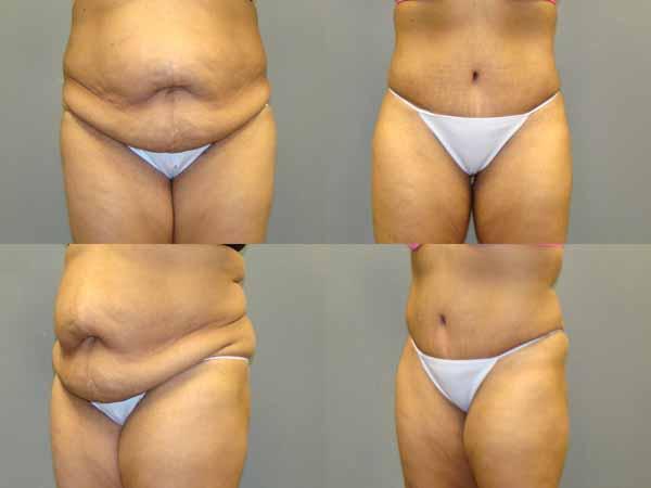 Tummy Tuck Before and After Pictures Savannah, GA