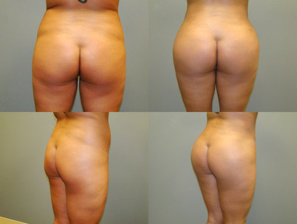 Brazilian Butt Lift Before and After Pictures Savannah, GA
