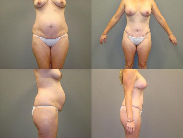 Tummy Tuck Before and After Pictures Savannah, GA