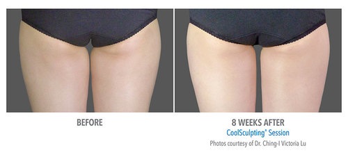 CoolSculpting® Before and After Pictures Savannah, GA